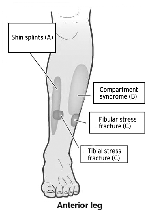 Figure 1: Common causes of shin pain and where they occur. A, Shin splints. B, Compartment syndrome. C, Stress fracture, fibula and tibia.