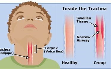 Image result for croup