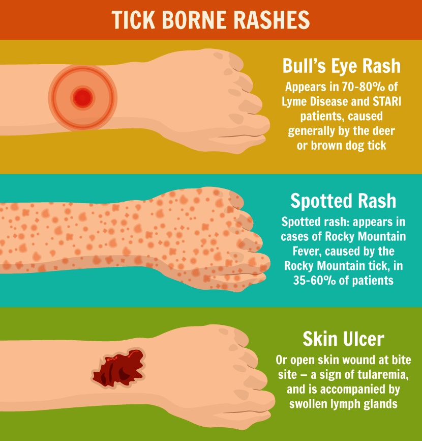 Pictures Of Rashes Caused By Tick Bites - PictureMeta