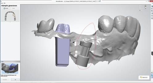 A 3d model of a tooth

Description automatically generated