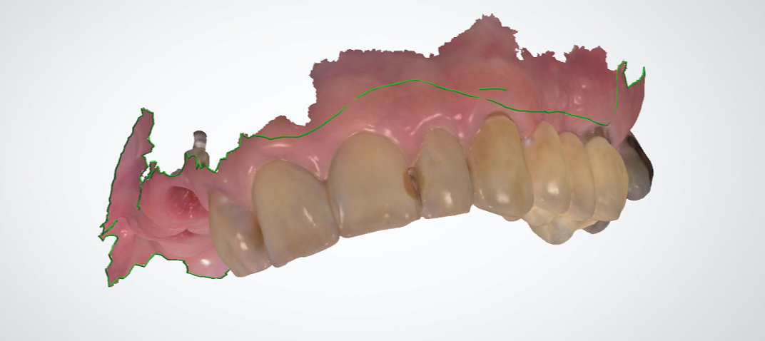 A close-up of a denture

Description automatically generated